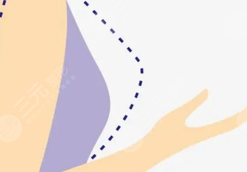 威宁之星假体隆胸价格是多少?