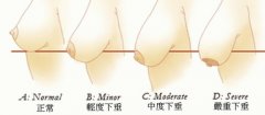 下垂胸怎么矫正，还有办法吗？2种手术科普！重拾傲人美波~