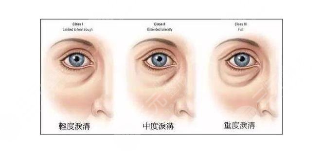 面部皱纹产生的原因