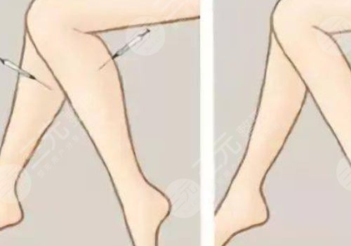 注射瘦腿会反弹吗？