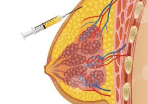 注射玻尿酸丰胸是什么?