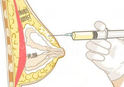 注射玻尿酸丰胸是什么?