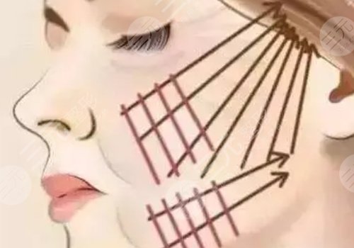 电波拉皮能维持多久?