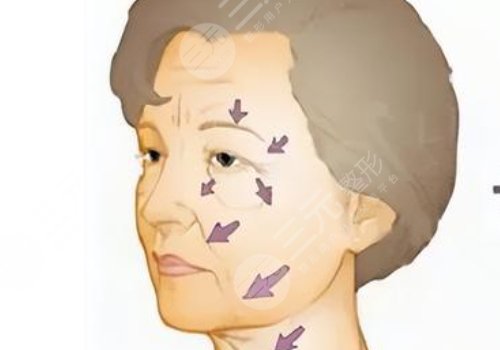 电波拉皮能维持多久?