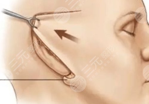 电波拉皮能维持多久?