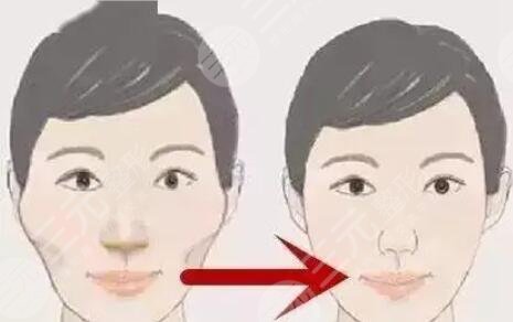 微创颧骨整形手术费用是多少?