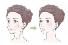 做面部拉皮的佳年龄？简单了解面部拉皮！