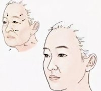 拉皮手术能维持几年？了解拉皮手术的优势与危害！