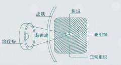 超声炮的价格是多少?有哪些因素影响? 超声炮的价格是多少?有哪些因素影响?