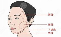 小拉皮手术怎么做？基本情况要了解！术后恢复注意这三点！