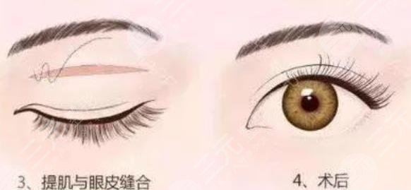 10°帕克美眼