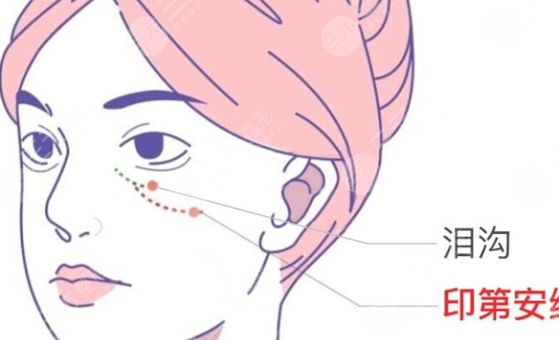 填充泪沟