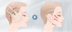 小拉皮和微拉美哪个效果好？手术原理分析，两种方式区别盘点