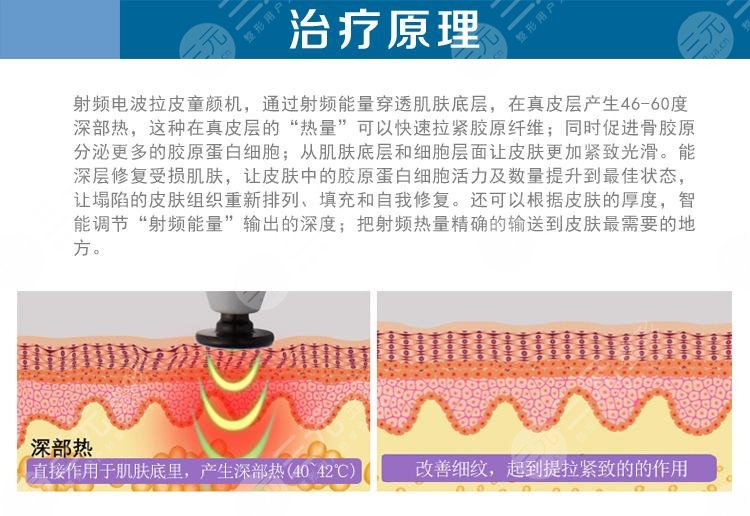 电波拉皮和热玛吉的区别在哪?