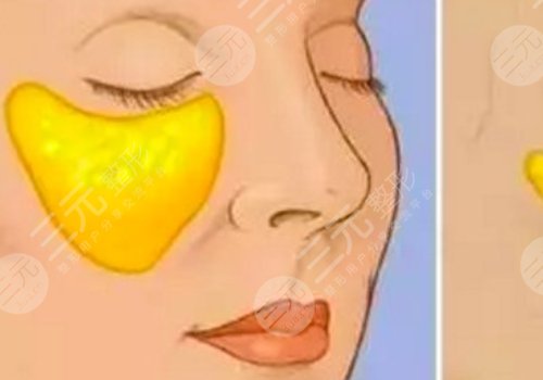 脸部填充用什么填充好？