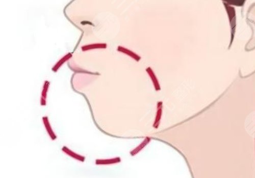 下颚线提升整形有什么做法？