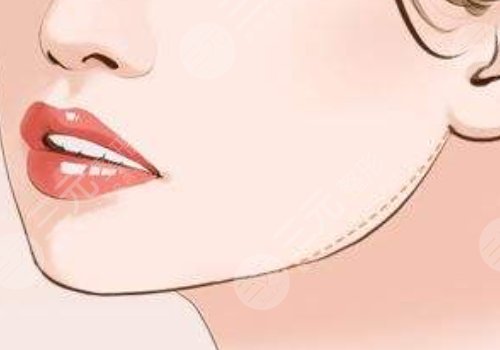 下颚线提升整形有什么做法？