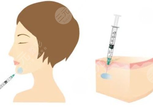 下颚线提升整形有什么做法？