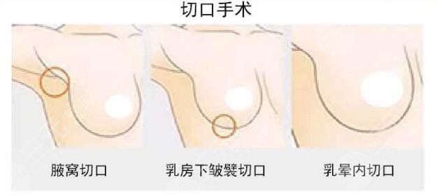 假体丰胸腋下切口多久能长好?