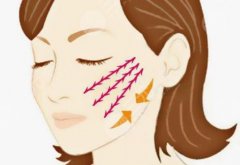 做小拉皮手术有危险吗？给你讲讲小拉皮手术潜在危险和相关知识！