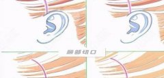 小拉皮手术切口图片：从五个方面简单科普小拉皮手术！
