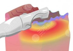 热玛吉和超声炮的区别?原理、使用方法、适用人群等帮你找到答案! 热玛吉和超声炮的区别?原理、使用方法、适用人群等帮你找到答案!