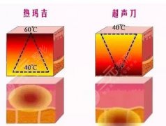 超声炮好还是热玛吉好?区分一下选择更加适合自己的项目! 超声炮好还是热玛吉好?区分一下选择更加适合自己的项目!