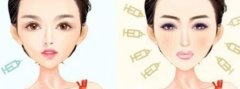 濡白天使针和丰颜哪个好?注射效果、价格和安全性都有区别! 濡白天使针和丰颜哪个好?注射效果、价格和安全性都有区别!