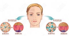 拉皮的副作用和危害：看看拉皮手术适合的年龄和注意事项！