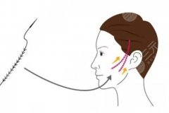 小拉皮手术适合多大年龄？选择小拉皮手术要注意术前术后护理！