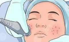 超声炮是什么美容项目?超声炮使用效果、操作流程、注意事项了解一下! 超声炮是什么美容项目?超声炮使用效果、操作流程、注意事项了解一下!