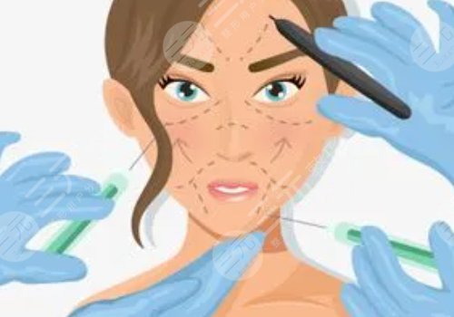 什么是面部轮廓提升针?