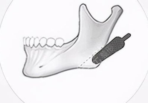 　　在日常的生活当中，如果有的爱美人士想要通过一些好的方式来改良面部内轮廓以及外轮廓的话，可以通过吸脂以及注射一些好的物质，还有手术的方式来进行改良。  　　做面部内轮廓以及外轮廓，建议爱美人士在手术之前做好对于自己脸部方面的检查，这样的话容易根据自己实际情况来选择合适的做这项手术的方式，也能够帮助爱美人士有效的排出脸部当中的一些脂肪，或者是改良爱美人士脸部当做一些比较突出的骨头。  　　达到一个比较理想的改良内外轮廓的效果。建议爱美人士如果咬合肌比较大的话，可以通过注射一些玻尿酸以及其他的物质来进行缓解，这样的话能够起到一定的整形手术效果。