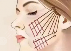 大拉皮手术大概多少钱？维持时间、后遗症、术后护理要了解！