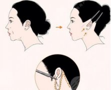 拉皮属于几级手术？适合什么年龄、术后头套戴多久一起看看吧！