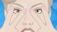 做小拉皮需要多少钱？术后效果和护理注意事项在这里！