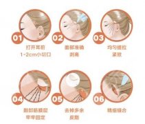 小切口拉皮手术可以维持多久？恢复期和花费也要了解一下！