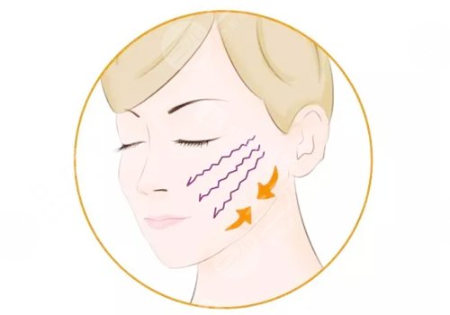 面部提升术一次大概多少钱