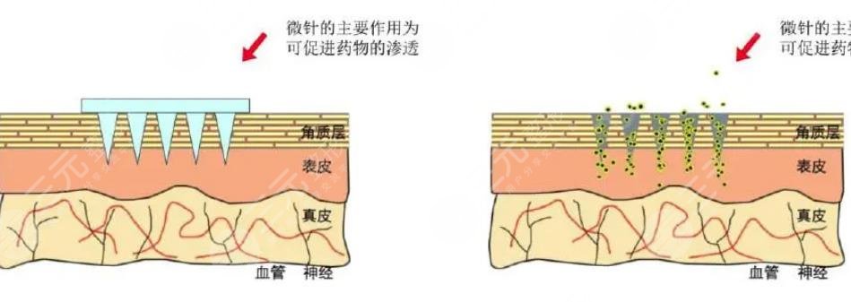 微针