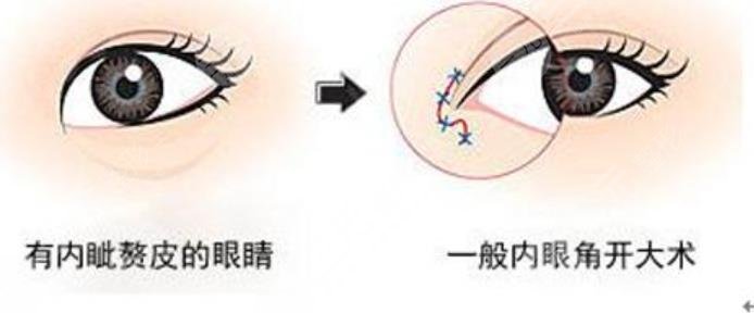 双眼皮