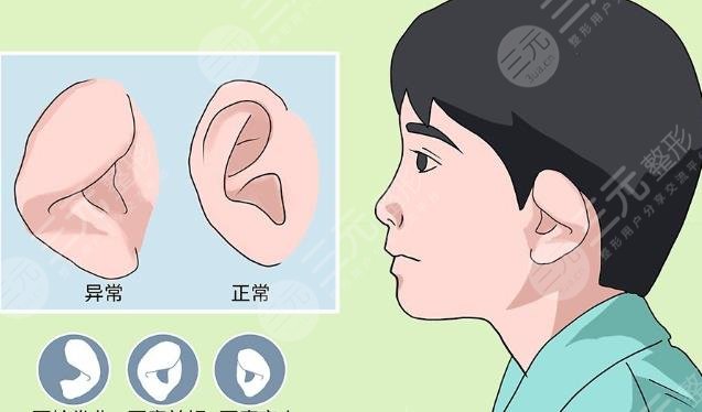 小耳畸形