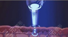 激光美白价格是多少？危害与效果你都了解了吗！