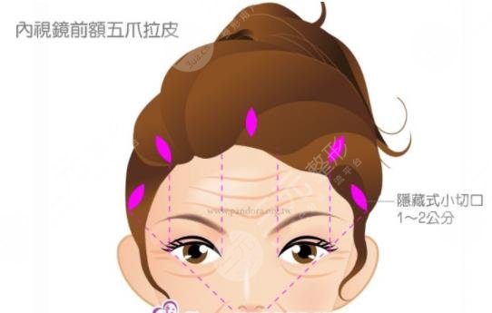 拉皮