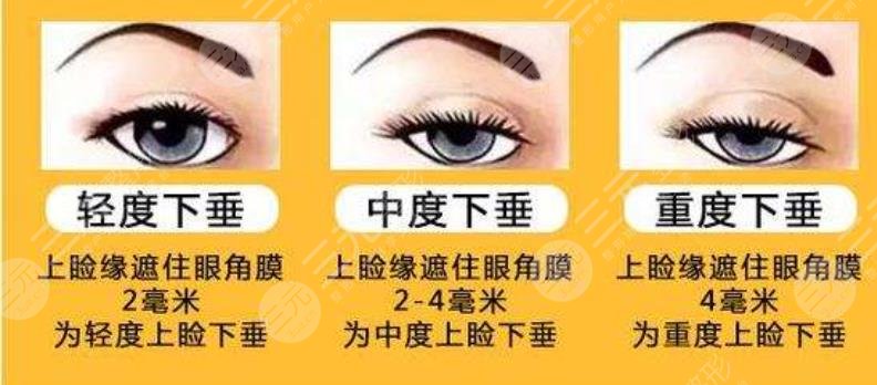上睑下垂\