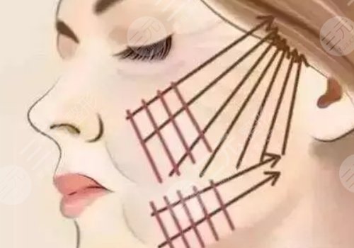 脸部下垂做超声刀好还是拉皮好呢？