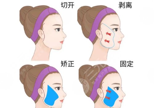 拉皮手术十年后的情况怎么样？会更老吗？