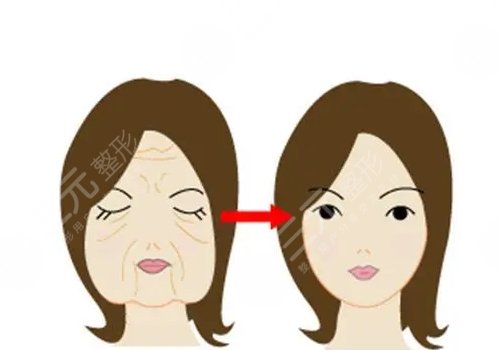 拉皮手术十年后的情况怎么样？会更老吗？