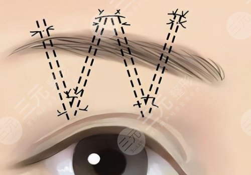 提眉的好处和坏处有什么？