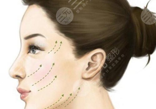 轮廓提升多久有效果？