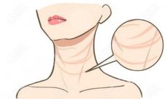 电波拉皮去颈纹如何护理？反弹？风险？痛感等科普！